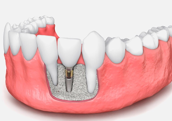 Regeneración-ósea-o-injerto-de-hueso-para-implantes-dentales