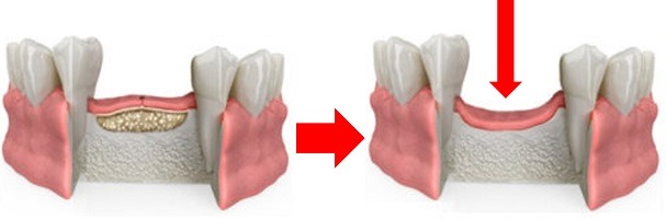 regeneracion-osea-guiada-dental-perdida-de-volumen-200x600px